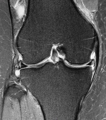 Figure 4 for case Meniscus tears ( RID2762 )